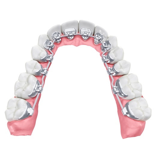 Лингвальная брекет-система